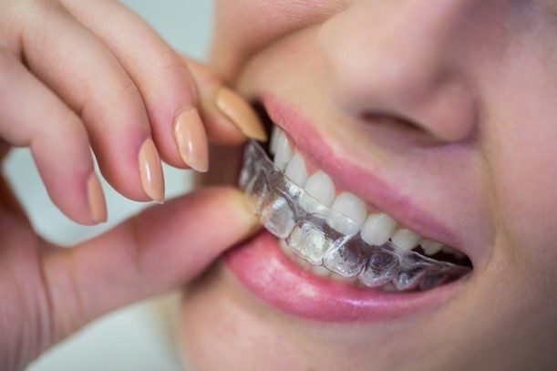 Benefits of Invisalign 