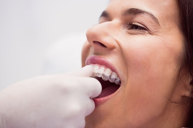 Invisalign Treatment Option