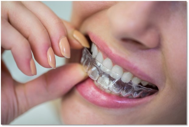 Invisalign teeth straightening